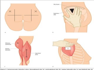 TYPES OF INJECTION AND INJECTION SITES.pptx