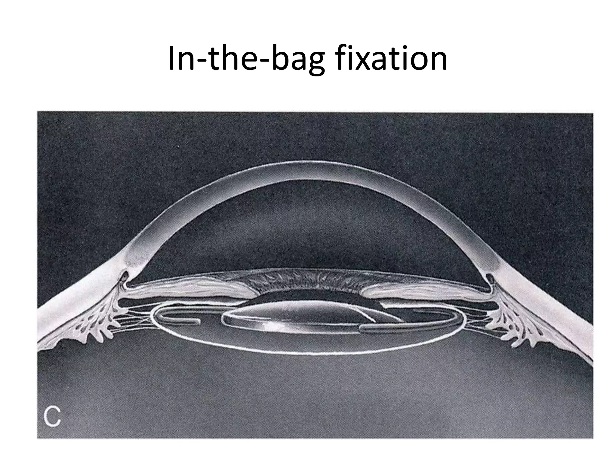 In-the-bag fixation
 