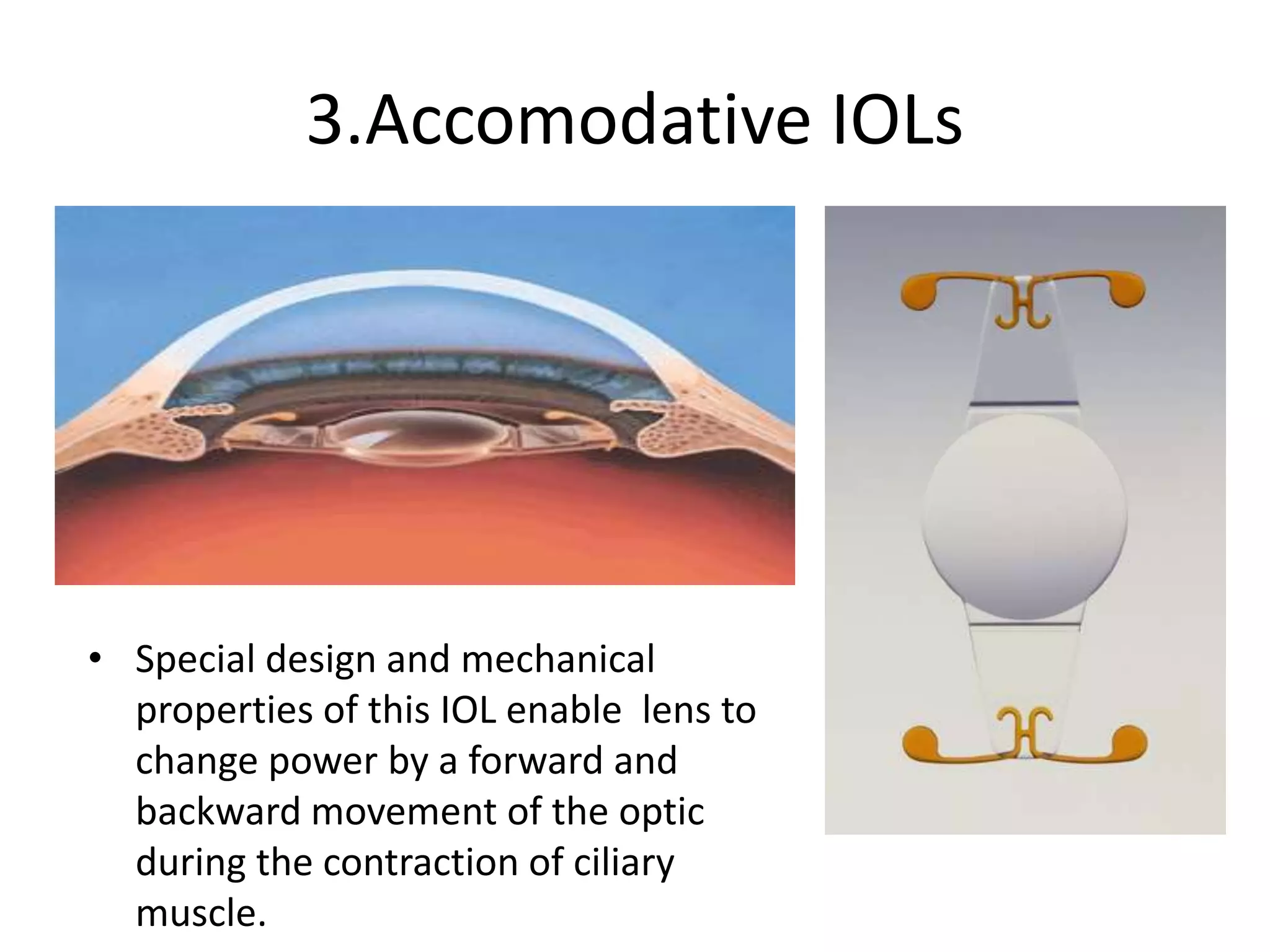 3.Accomodative IOLs
• Special design and mechanical
properties of this IOL enable lens to
change power by a forward and
backward movement of the optic
during the contraction of ciliary
muscle.
 