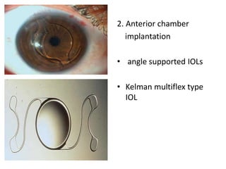 Types of iol | PPTX