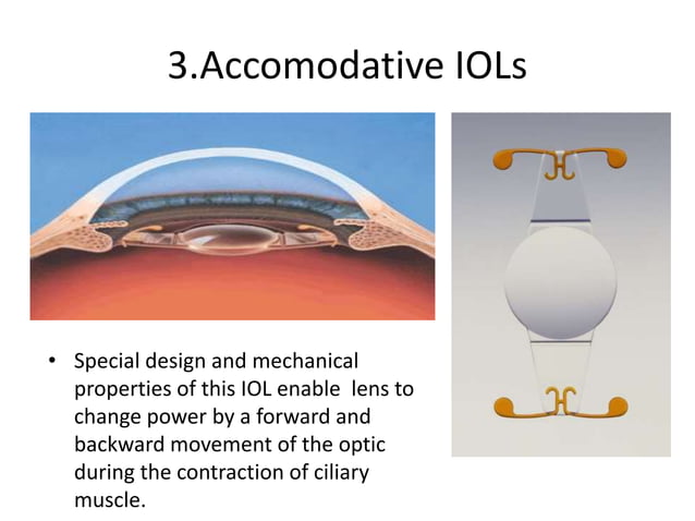 Secondary Iols Four Ways , Secondary IOL Fixation: Know Your Options ...