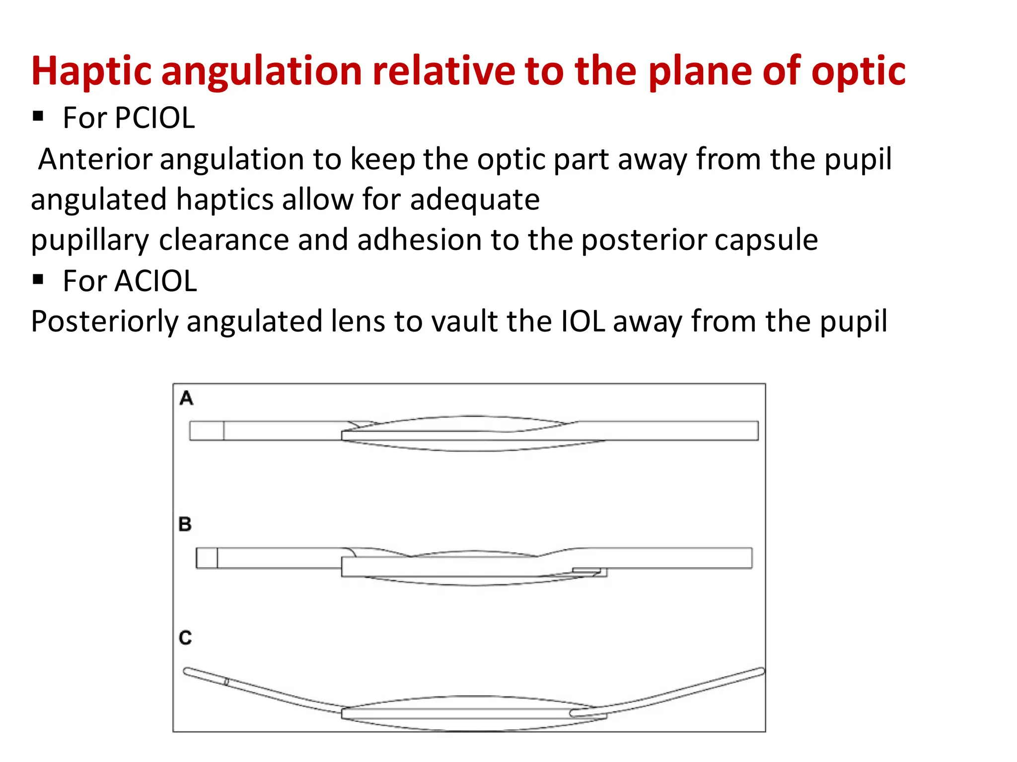 Haptic angulation relative to the plane of optic
▪ For PCIOL
Anterior angulation to keep the optic part away from the pupil
angulated haptics allow for adequate
pupillary clearance and adhesion to the posterior capsule
▪ For ACIOL
Posteriorly angulated lens to vault the IOL away from the pupil
 