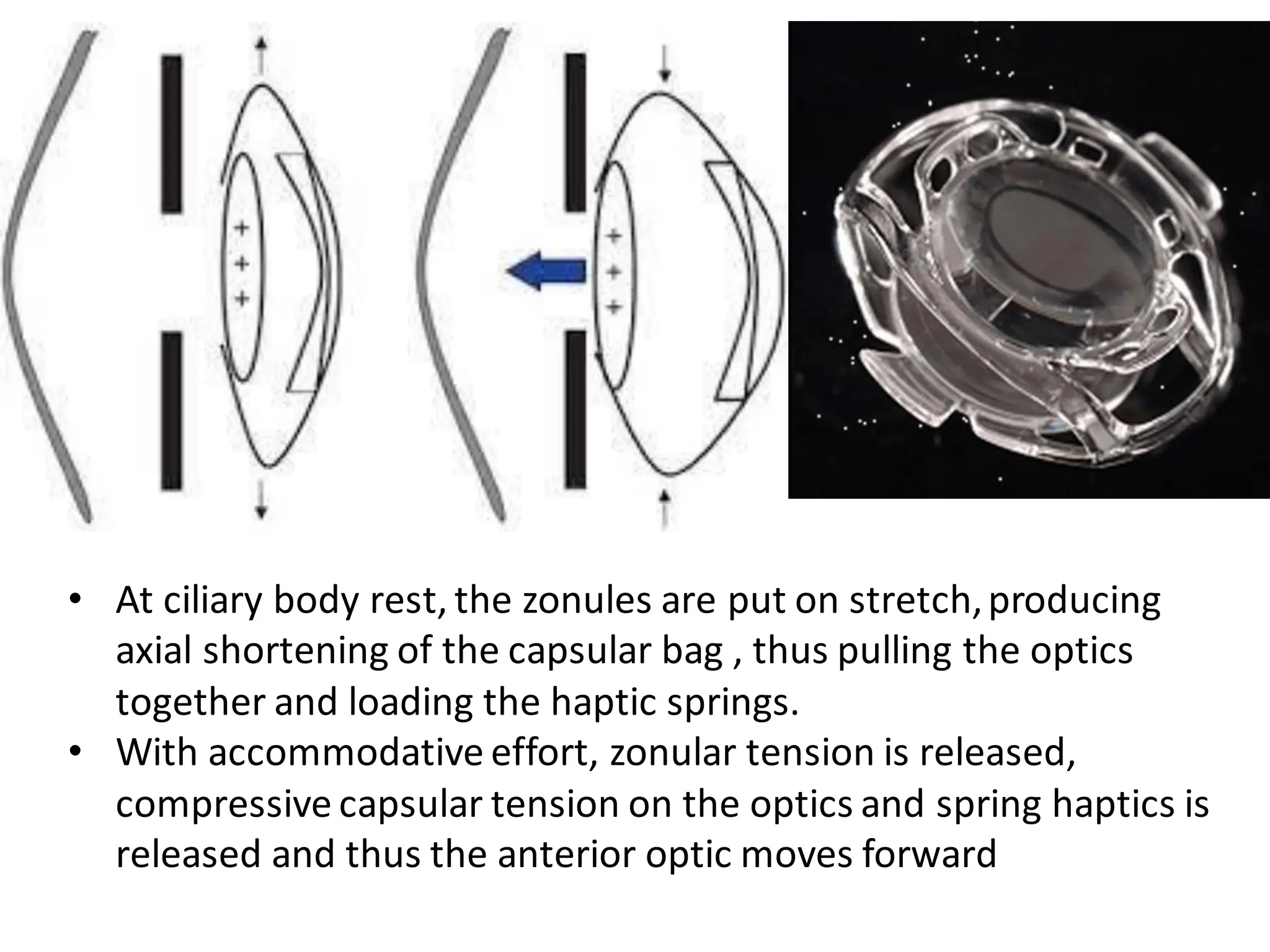 • At ciliary body rest, the zonules are put on stretch,producing
axial shortening of the capsular bag , thus pulling the optics
together and loading the haptic springs.
• With accommodative effort, zonular tension is released,
compressive capsular tension on the optics and spring haptics is
released and thus the anterior optic moves forward
 