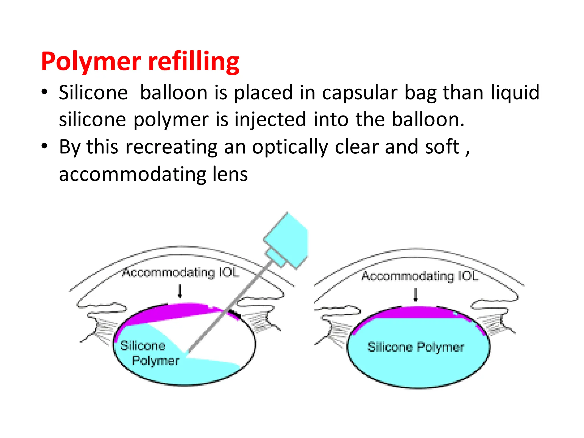 Polymer refilling
• Silicone balloon is placed in capsular bag than liquid
silicone polymer is injected into the balloon.
• By this recreating an optically clear and soft ,
accommodating lens
 