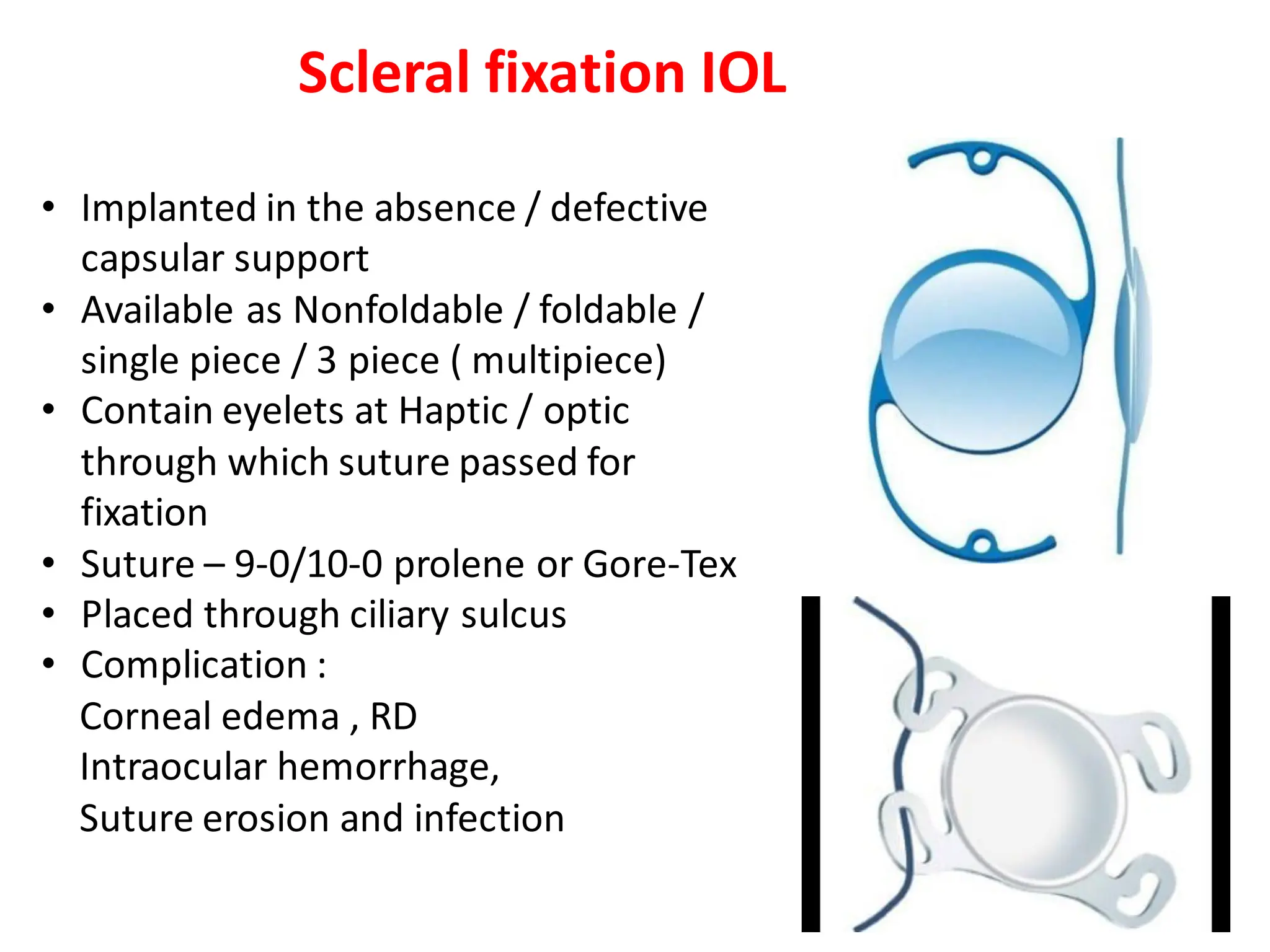 Scleral fixation IOL
• Implanted in the absence / defective
capsular support
• Available as Nonfoldable / foldable /
single piece / 3 piece ( multipiece)
• Contain eyelets at Haptic / optic
through which suture passed for
fixation
• Suture – 9-0/10-0 prolene or Gore-Tex
• Placed through ciliary sulcus
• Complication :
Corneal edema , RD
Intraocular hemorrhage,
Suture erosion and infection
 