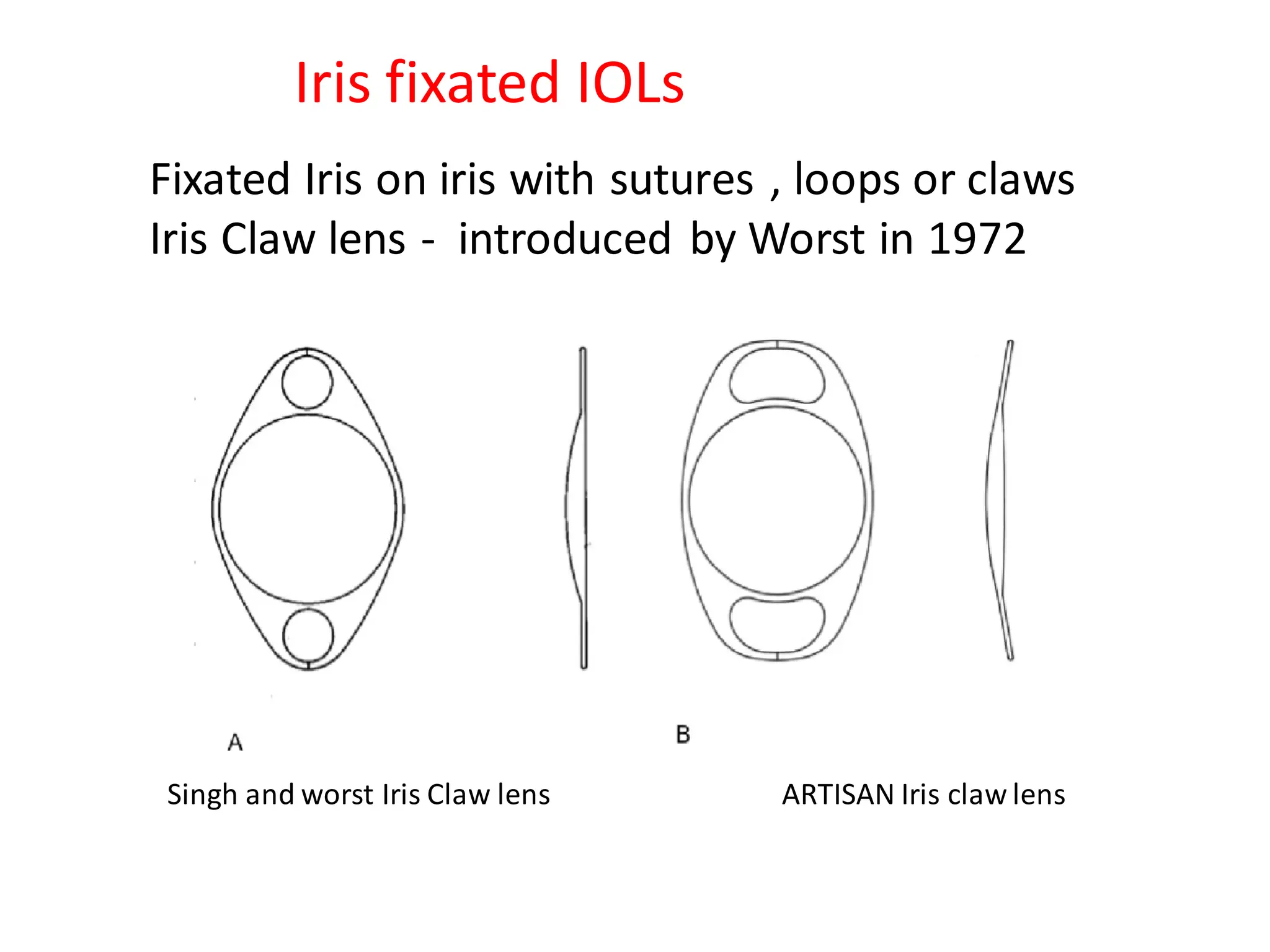 Iris fixated IOLs
Fixated Iris on iris with sutures , loops or claws
Iris Claw lens - introduced by Worst in 1972
Singh and worst Iris Claw lens ARTISAN Iris claw lens
 