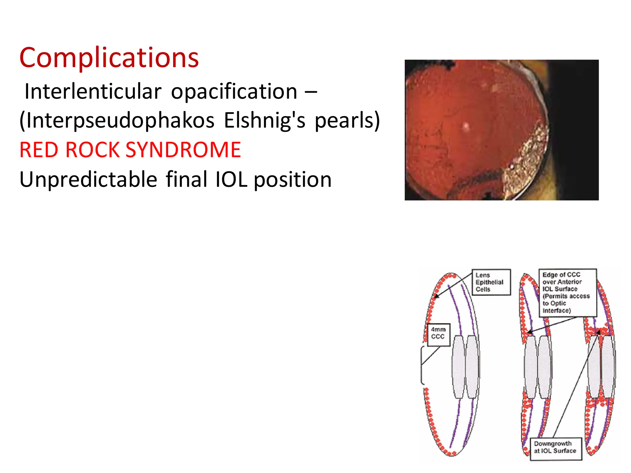 Complications
Interlenticular opacification –
(Interpseudophakos Elshnig's pearls)
RED ROCK SYNDROME
Unpredictable final IOL position
 