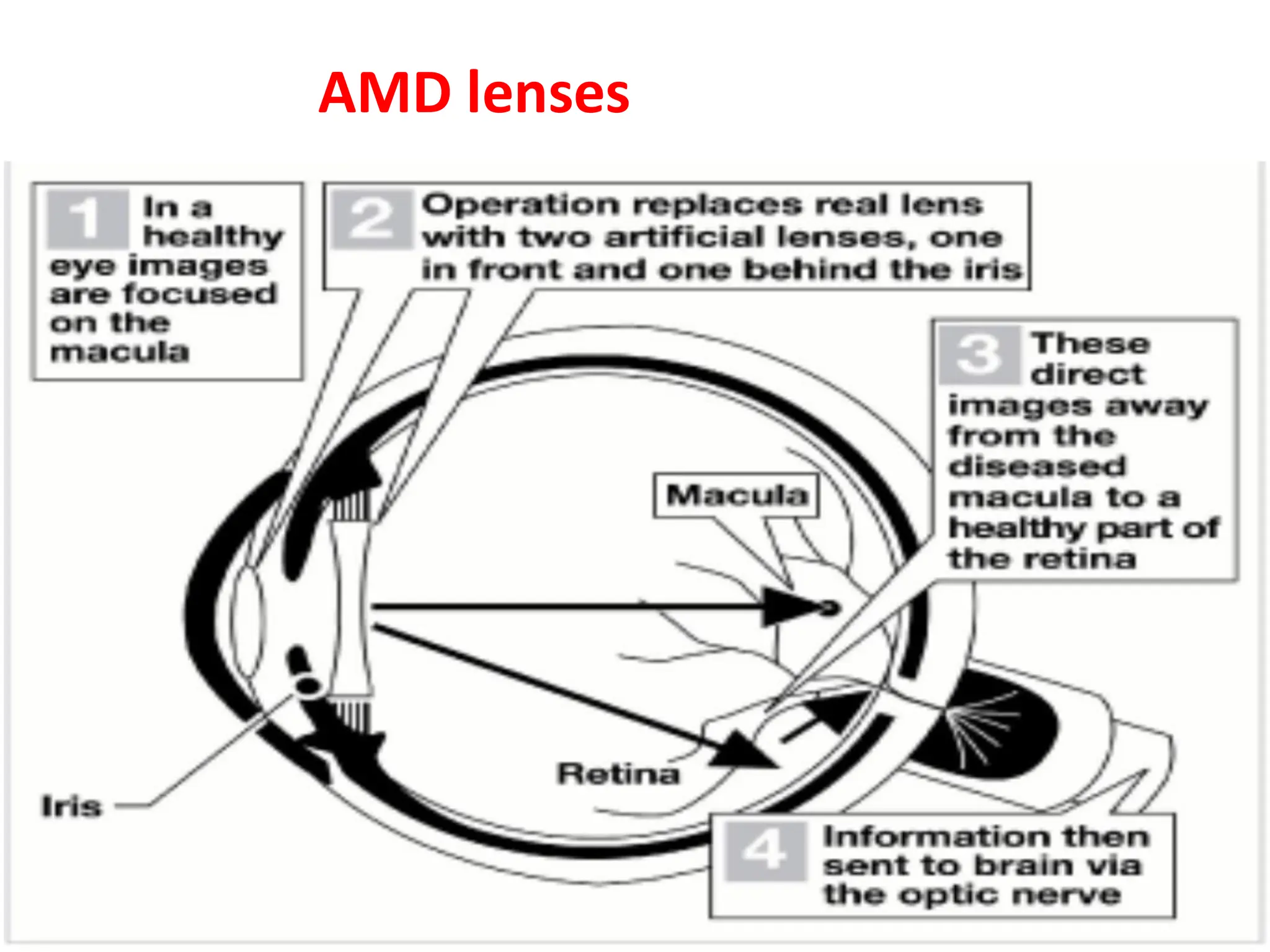 AMD lenses
 