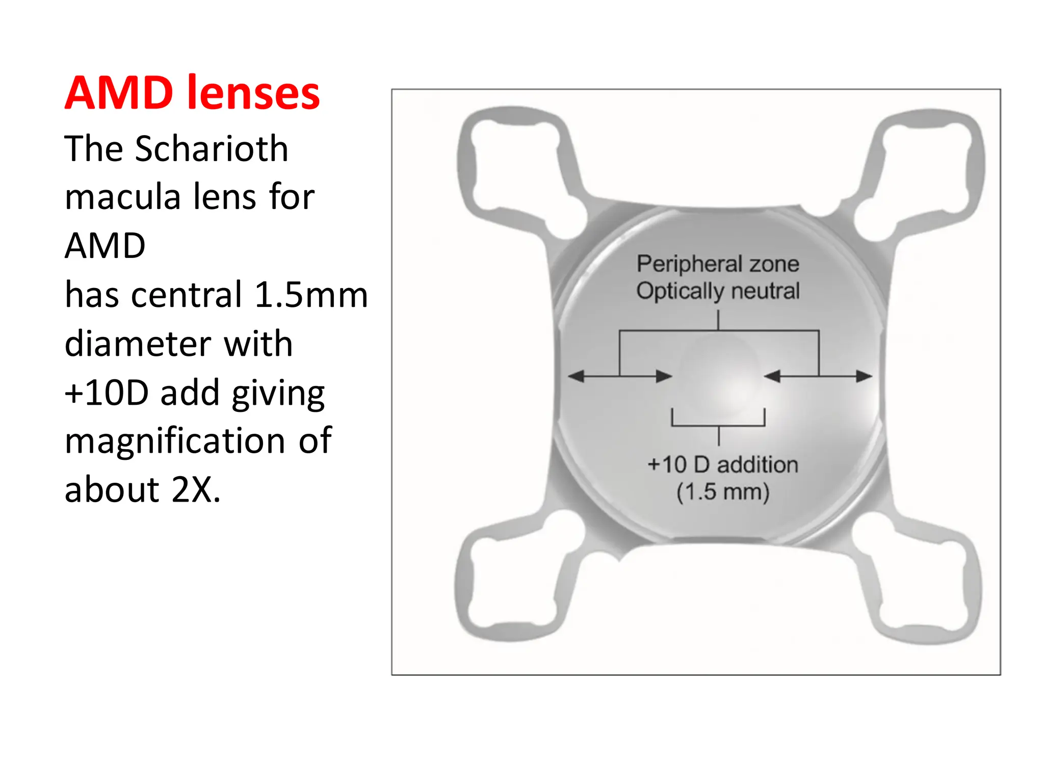 AMD lenses
The Scharioth
macula lens for
AMD
has central 1.5mm
diameter with
+10D add giving
magnification of
about 2X.
 