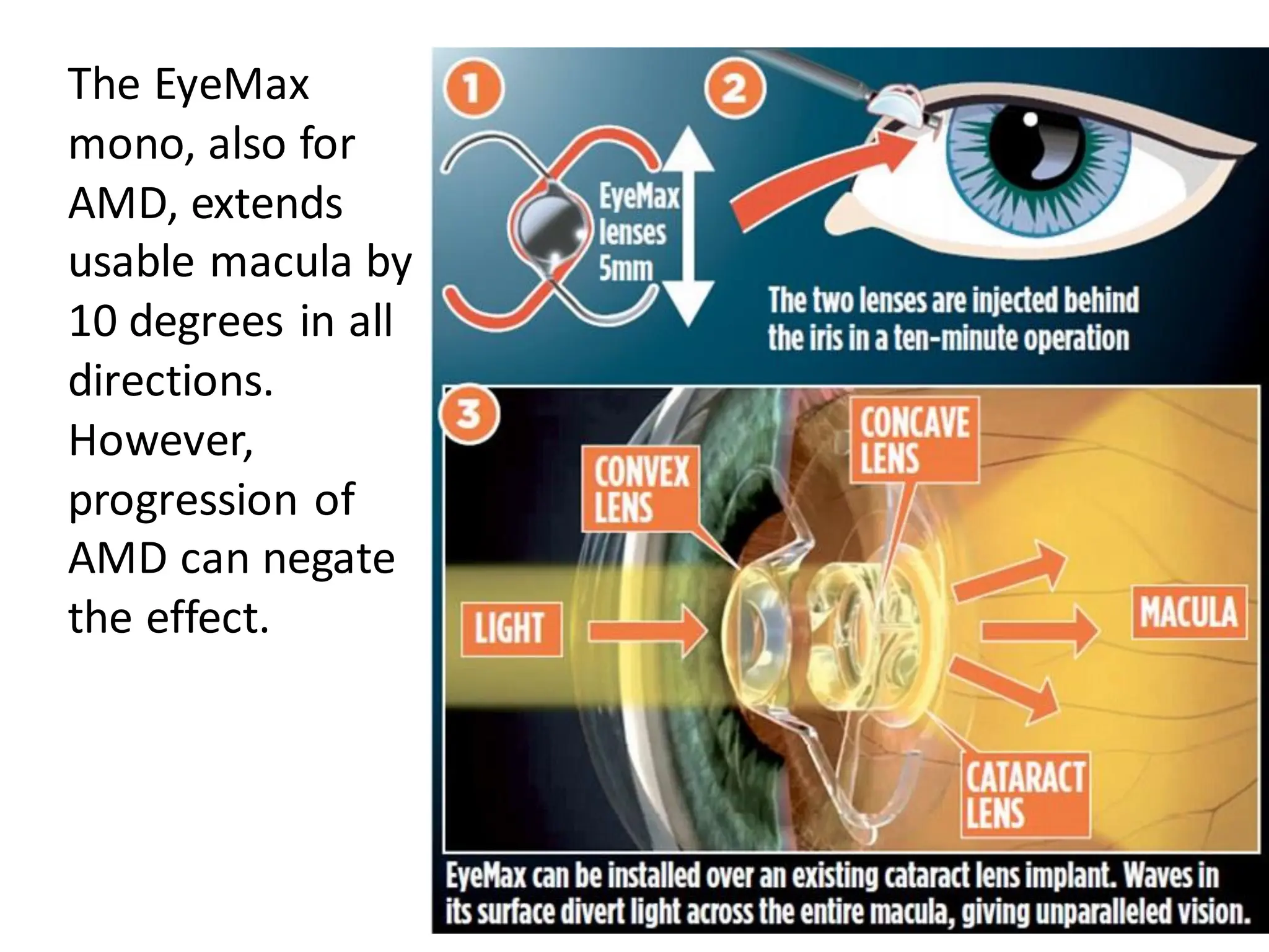 The EyeMax
mono, also for
AMD, extends
usable macula by
10 degrees in all
directions.
However,
progression of
AMD can negate
the effect.
 