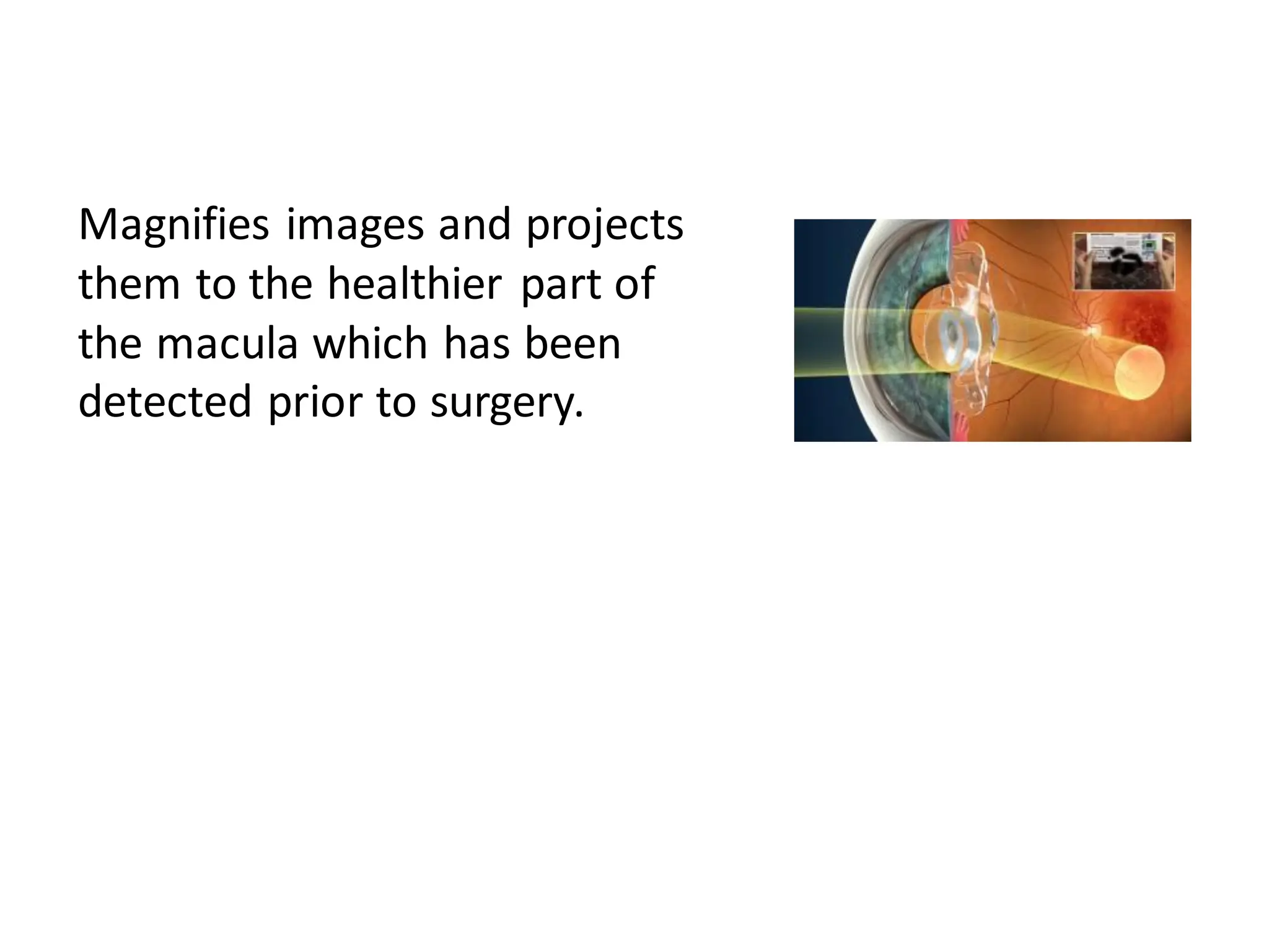 Magnifies images and projects
them to the healthier part of
the macula which has been
detected prior to surgery.
 