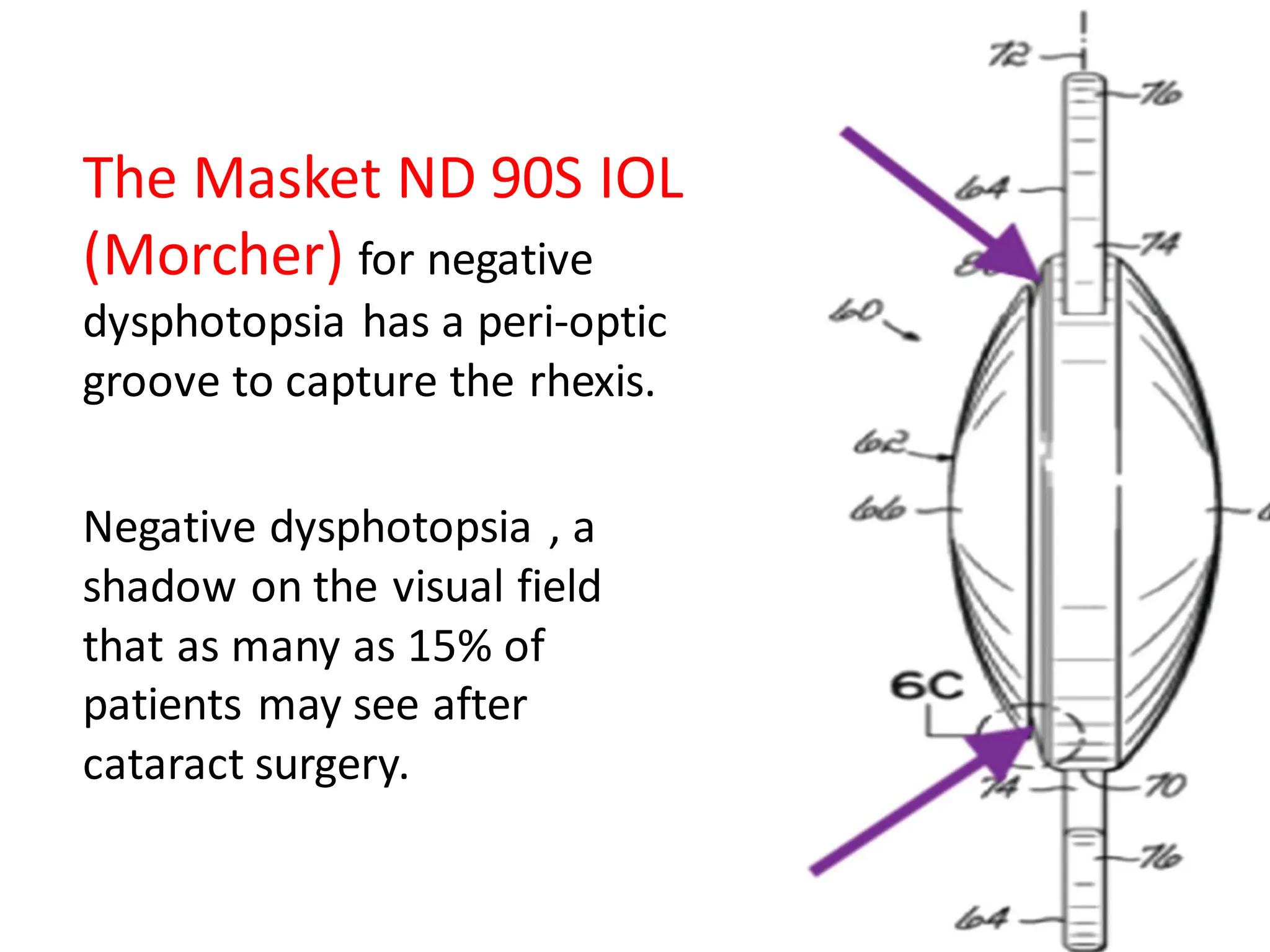 The Masket ND 90S IOL
(Morcher) for negative
dysphotopsia has a peri-optic
groove to capture the rhexis.
Negative dysphotopsia , a
shadow on the visual field
that as many as 15% of
patients may see after
cataract surgery.
 
