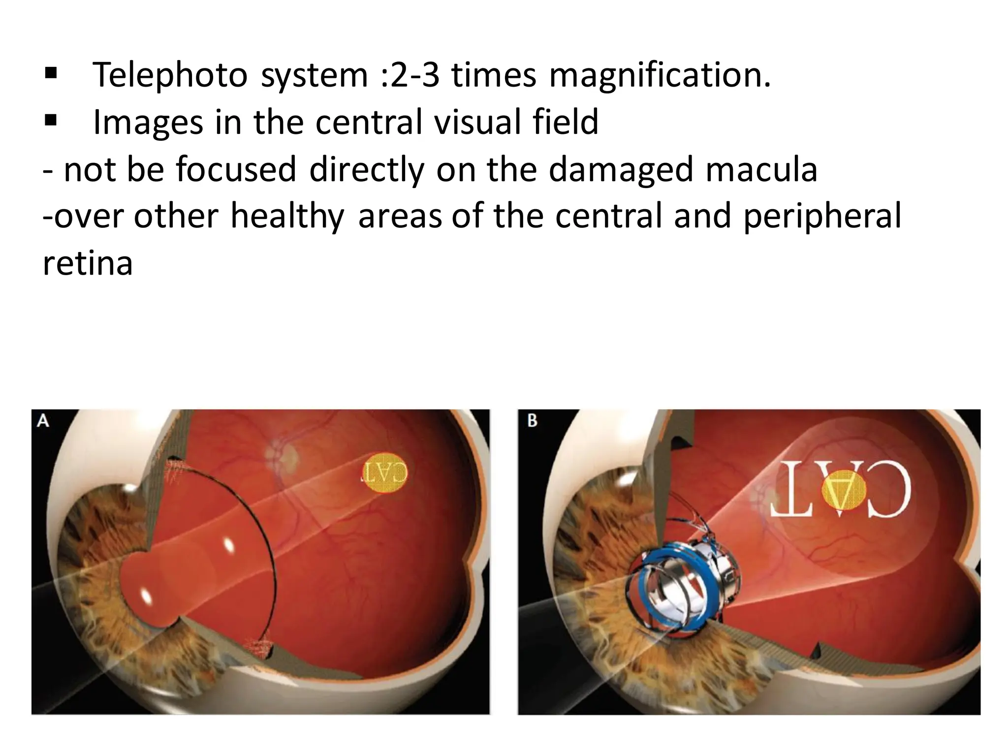 ▪ Telephoto system :2-3 times magnification.
▪ Images in the central visual field
- not be focused directly on the damaged macula
-over other healthy areas of the central and peripheral
retina
 