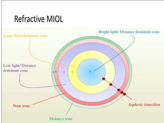 Types of IOL and Microlentics-2.pdf iol p | PDF