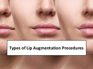 Types of Lip Augmentation Procedures
 