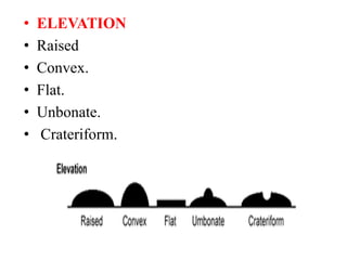 • ELEVATION
• Raised
• Convex.
• Flat.
• Unbonate.
• Crateriform.
 