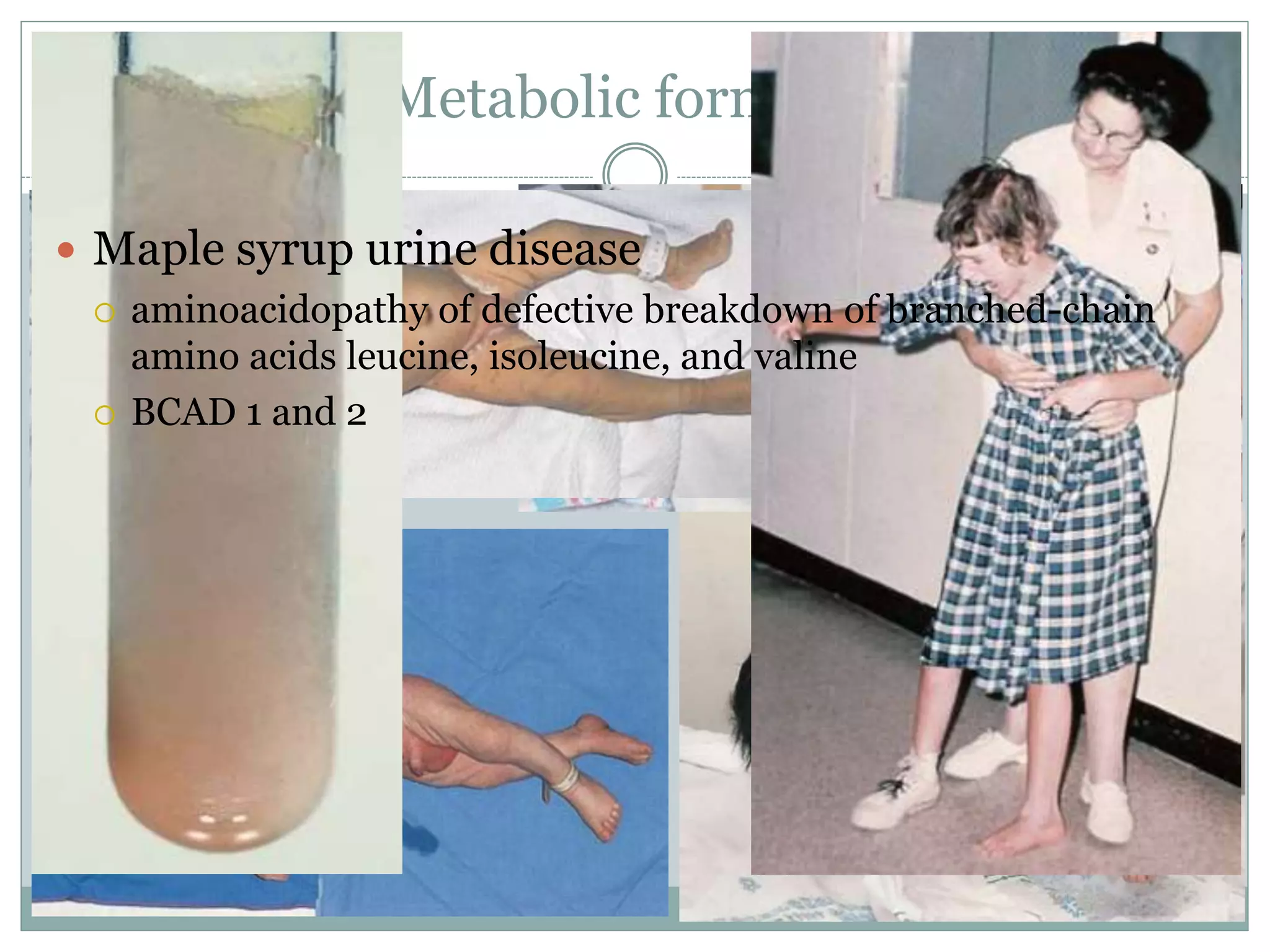 Metabolic formulas
 Maple syrup urine disease
 aminoacidopathy of defective breakdown of branched-chain
amino acids leucine, isoleucine, and valine
 BCAD 1 and 2
 