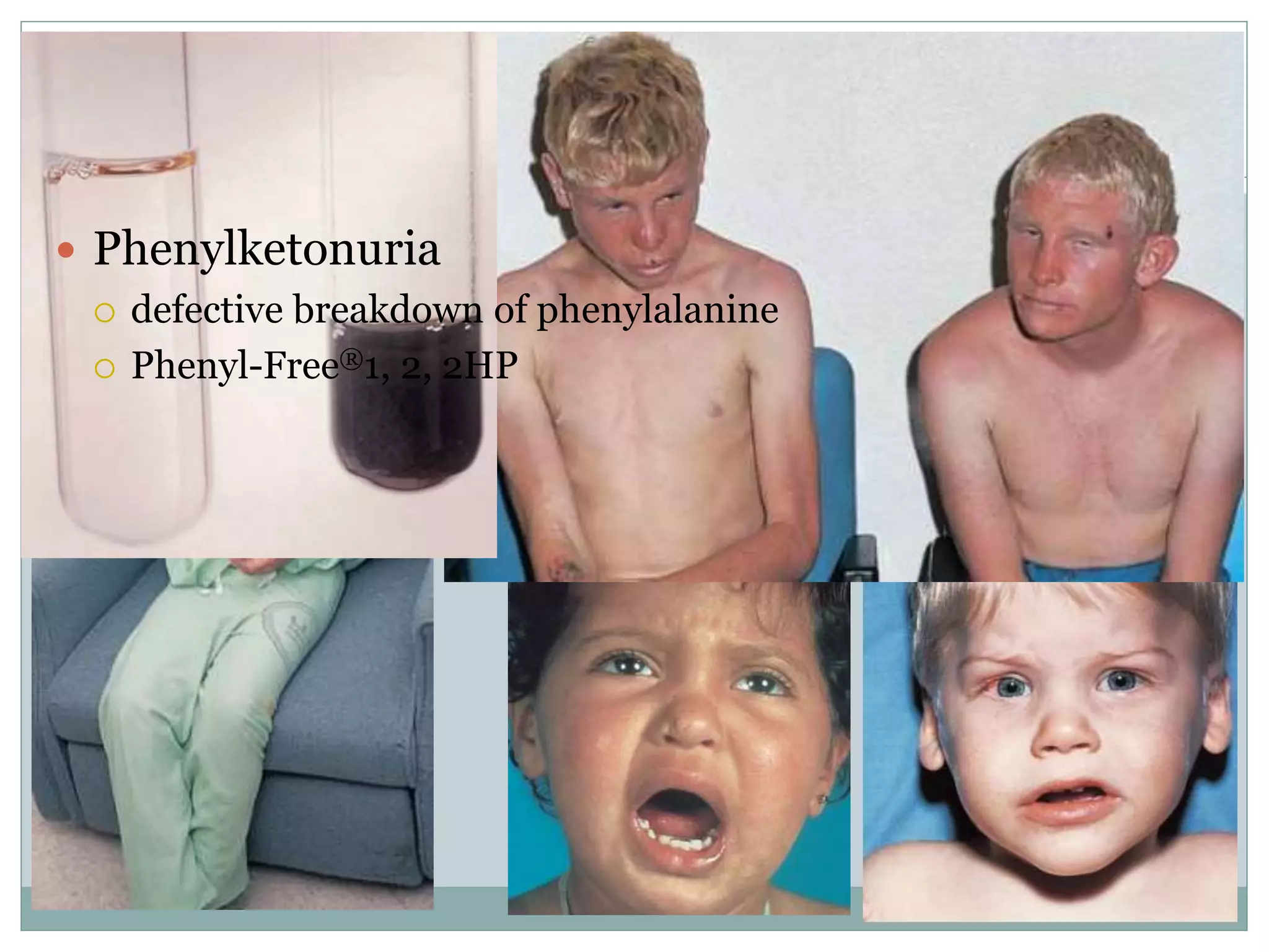 Metabolic formulas
 Phenylketonuria
 defective breakdown of phenylalanine
 Phenyl-Free®1, 2, 2HP
 