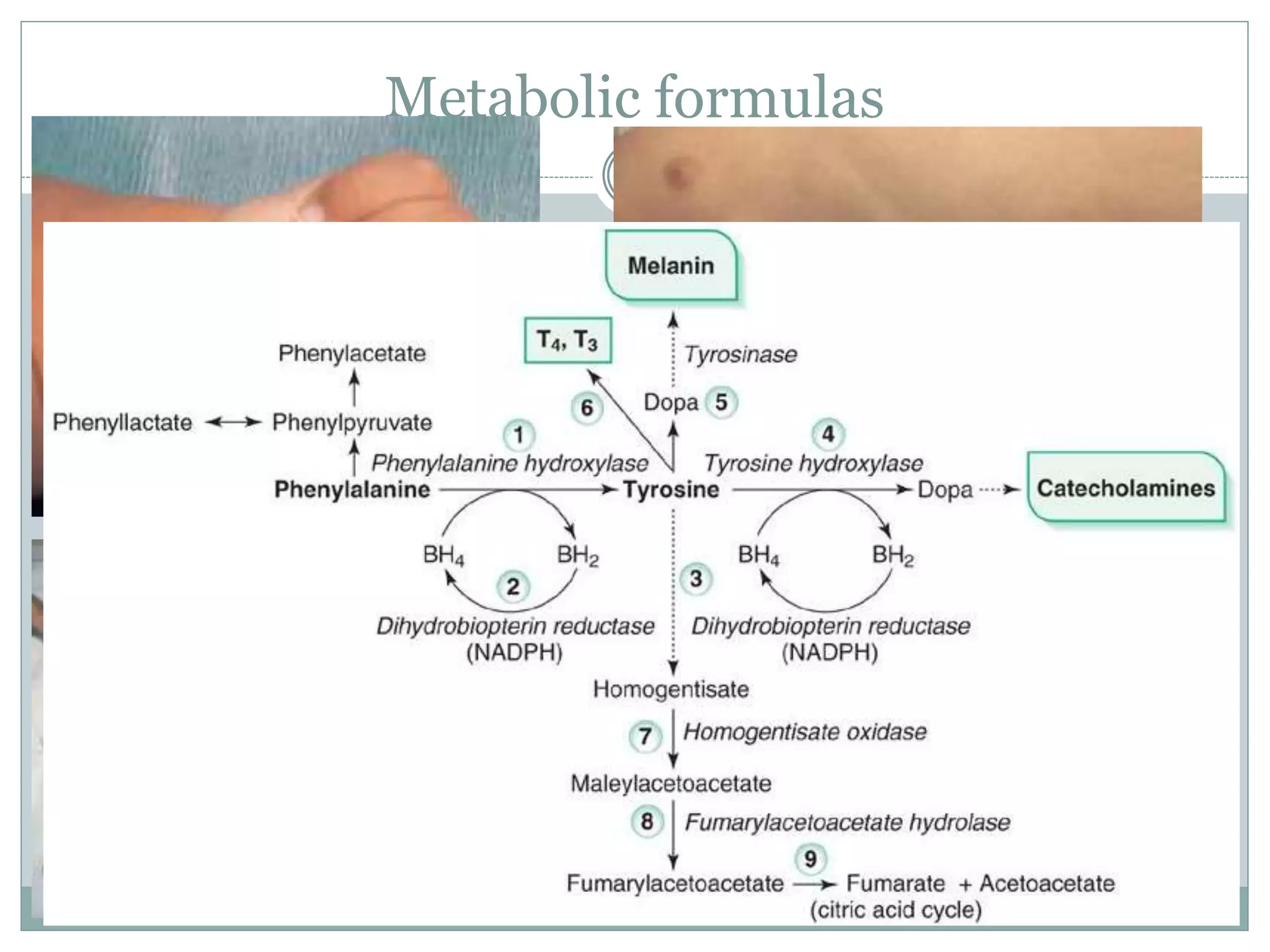 Metabolic formulas
 Tyrosinemia
 inability to metabolize fumarylacetoacetatic acid
 TYROS 1 and 2
 
