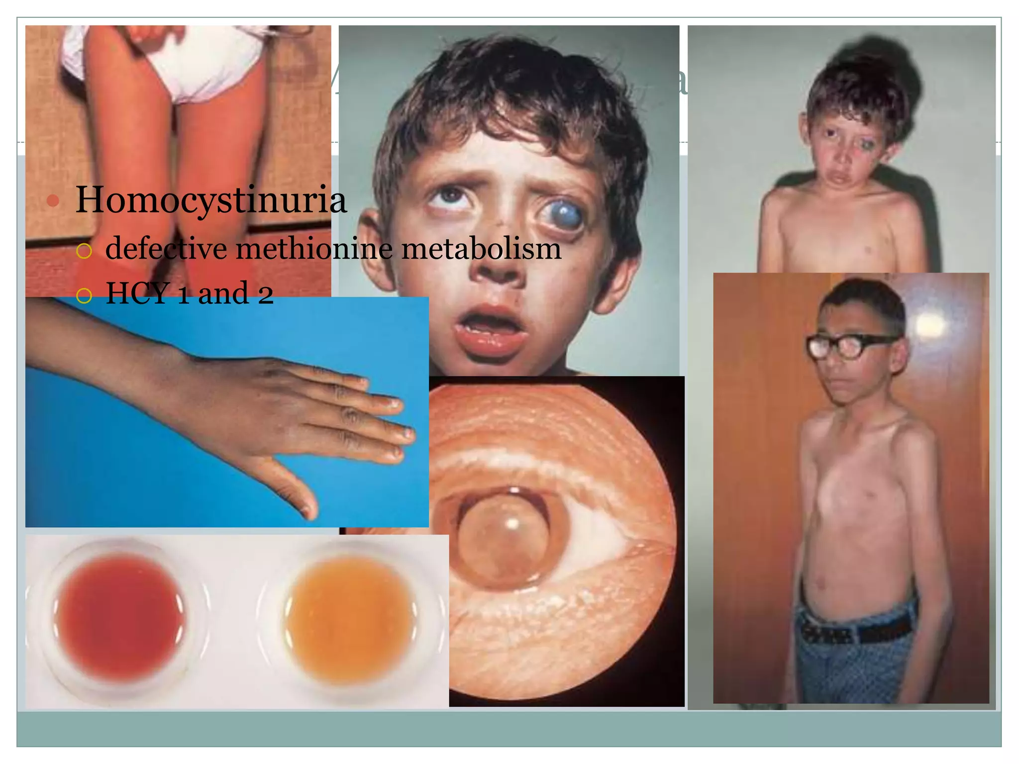 Metabolic formulas
 Homocystinuria
 defective methionine metabolism
 HCY 1 and 2
 