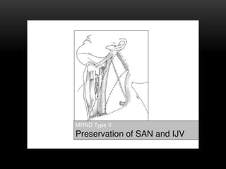Neck Dissection Rcpa Types of neck dissection | PPTX
