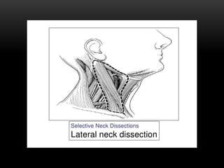 Types of neck dissection | PPTX