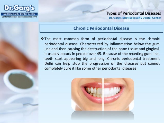 Types of Periodontal Diseases