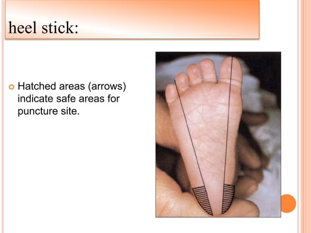 Puncturing Def Types of punctures | PPT