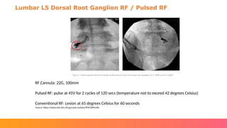 Types of Radiofrequency Ablation Procedures (Avanos).pptx