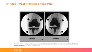 Knee Rfa Procedure Types of Radiofrequency Ablation Procedures (Avanos).pptx