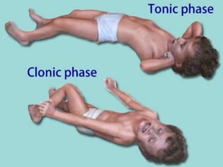 Generalized Tonic Clonic Seizures
 