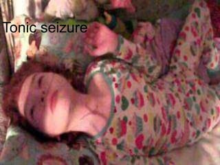 Tonic seizure
 