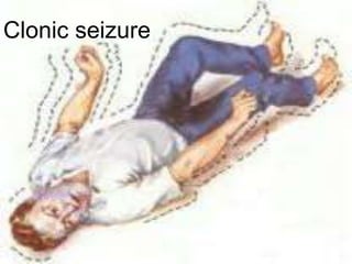 Clonic seizure
 