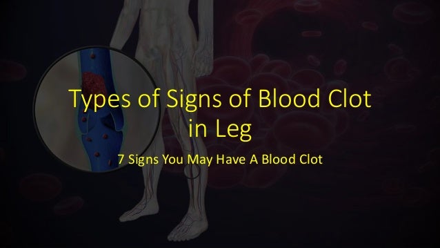 Types of Signs of Blood Clot in Leg - 7 Signs You May Have ...