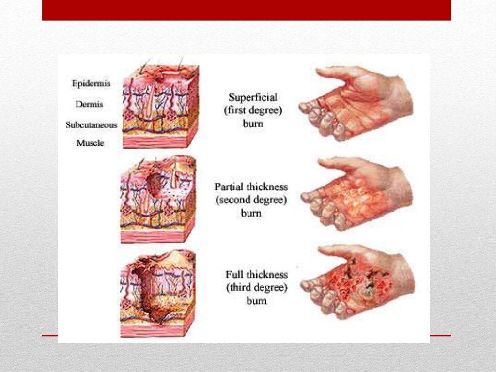 what are the three different types of burns