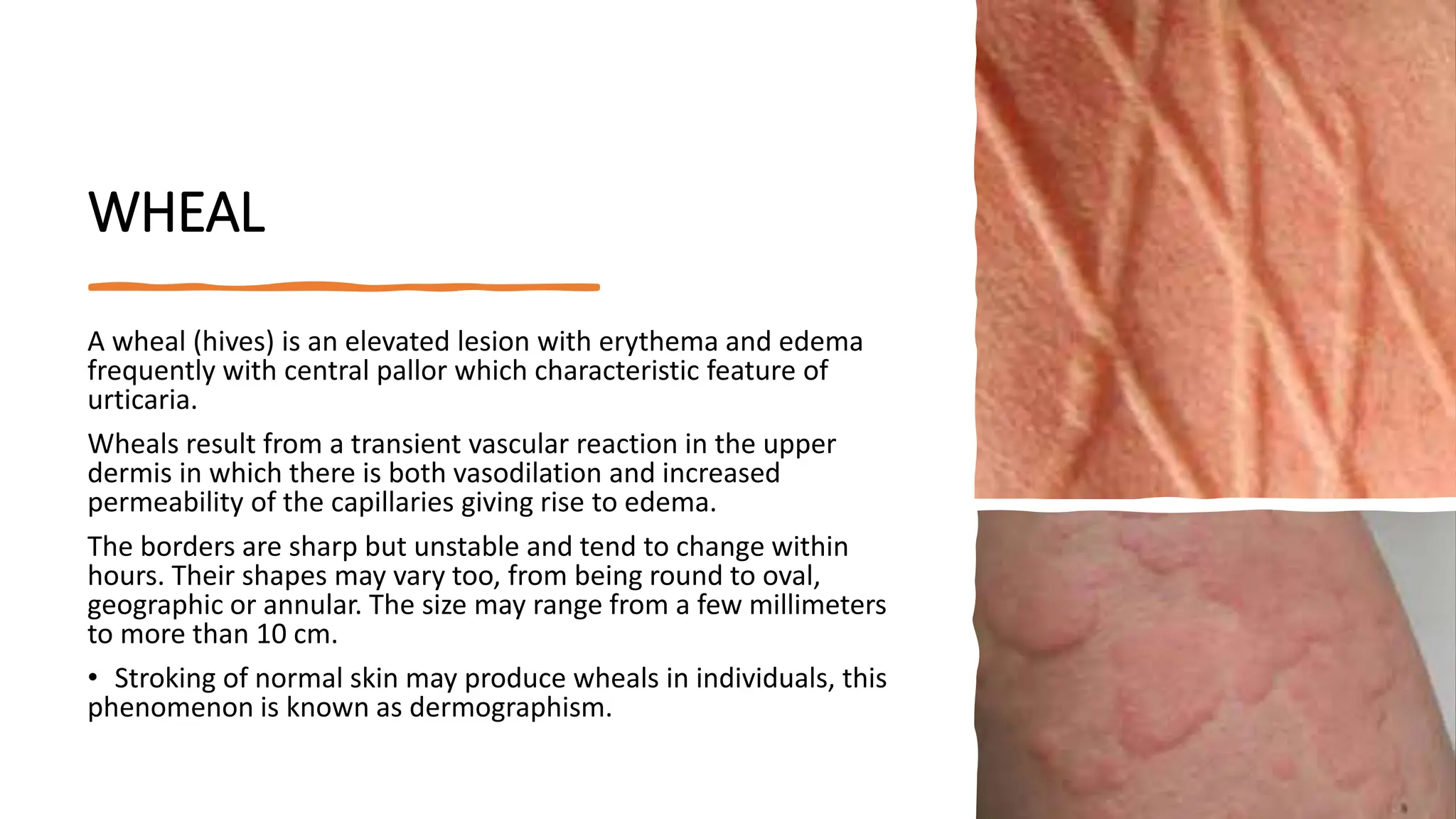 Wheals Examples Clinical Classification of Skin Lesions: A Morphological Approach in ...