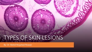 TYPES OF SKIN LESIONS
By: Dr. Mohd Mujahed Rizwan
 