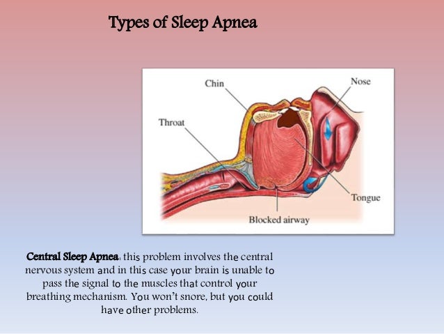 Types of sleep apnea