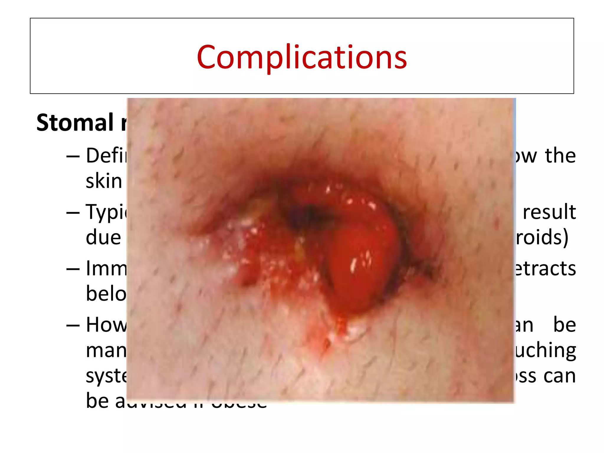 Types of intestinal stomas and management | PPTX