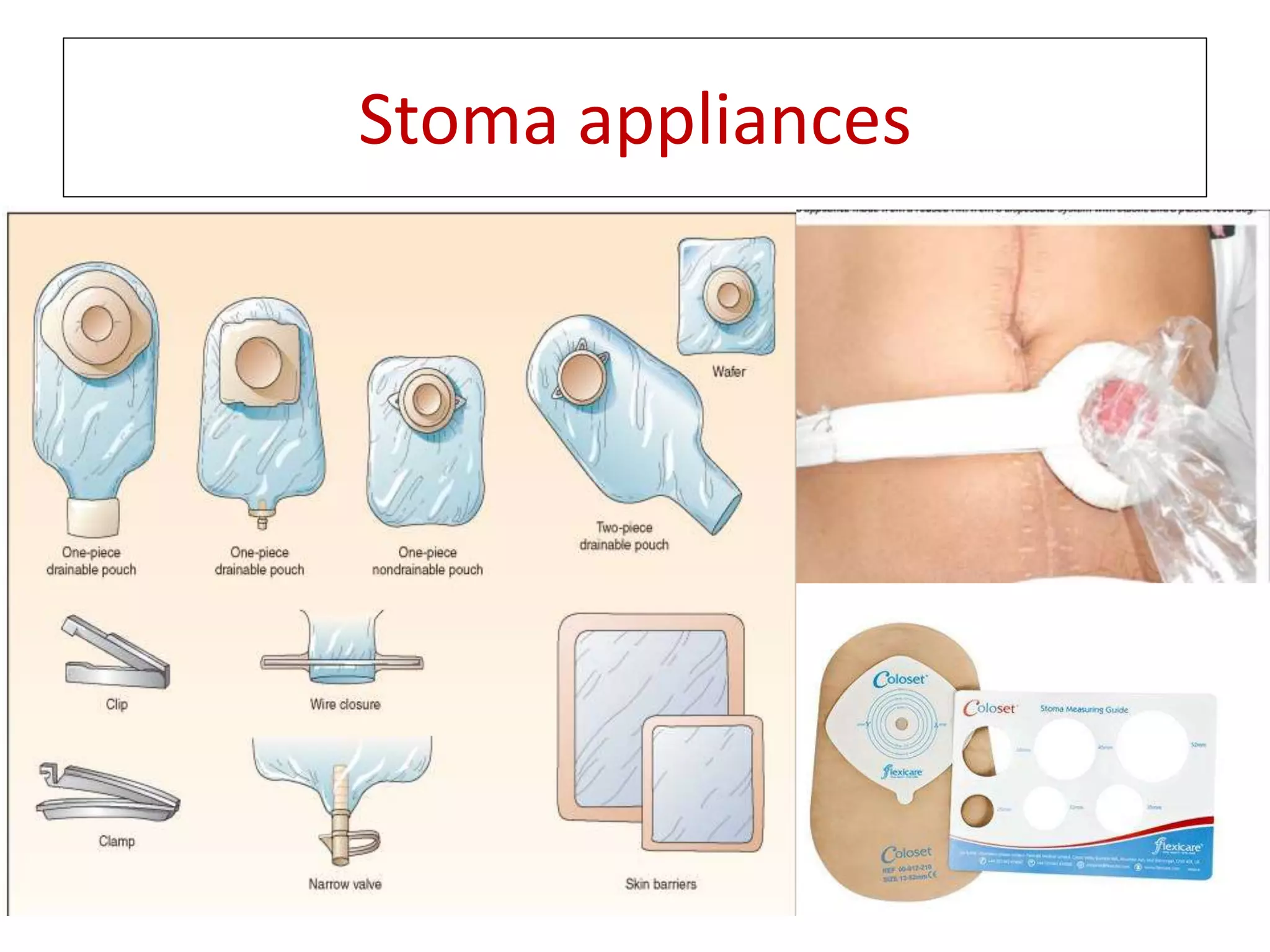 Types of intestinal stomas and management | PPTX