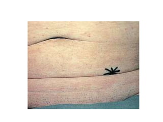 Types of intestinal stomas and management | PPTX