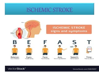 ISCHEMIC STROKE
 