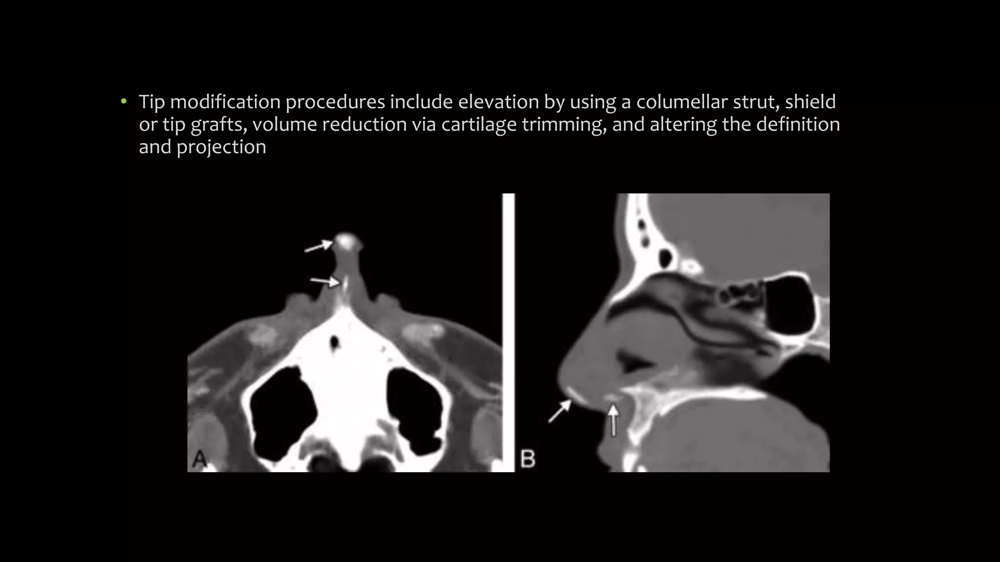 Types of surgery rhinoplasty | PPTX
