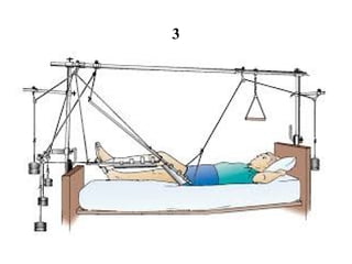 Compression Traction Signe Virtual Sign Identification of Traction Types in Medical Surgical ...