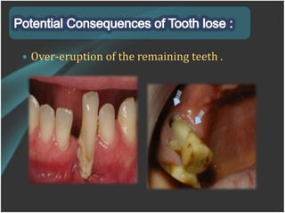 Over Eruption Types of treatments in patients who need oral rehabilitation | PPTX