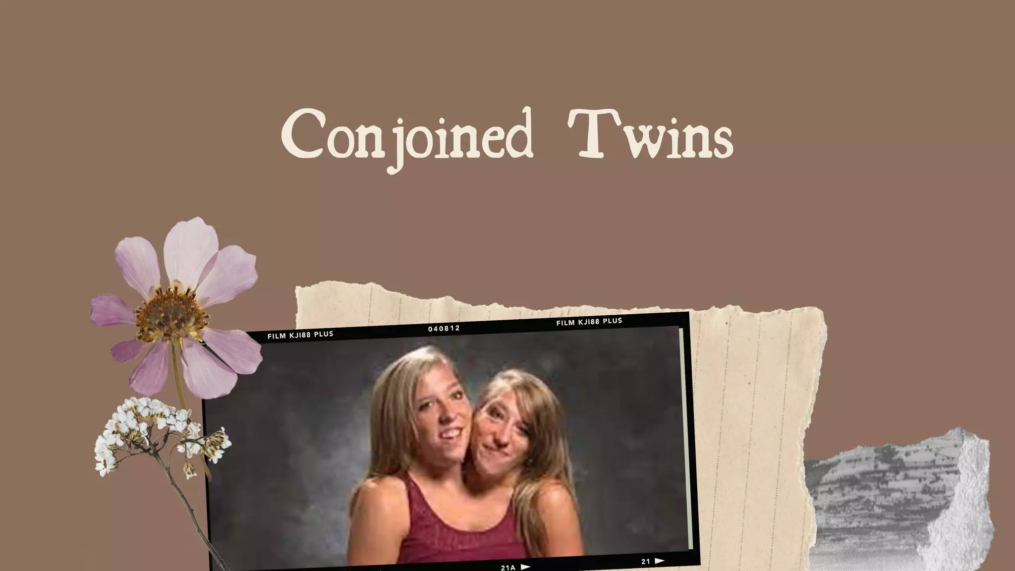 Conjoined Twins
 