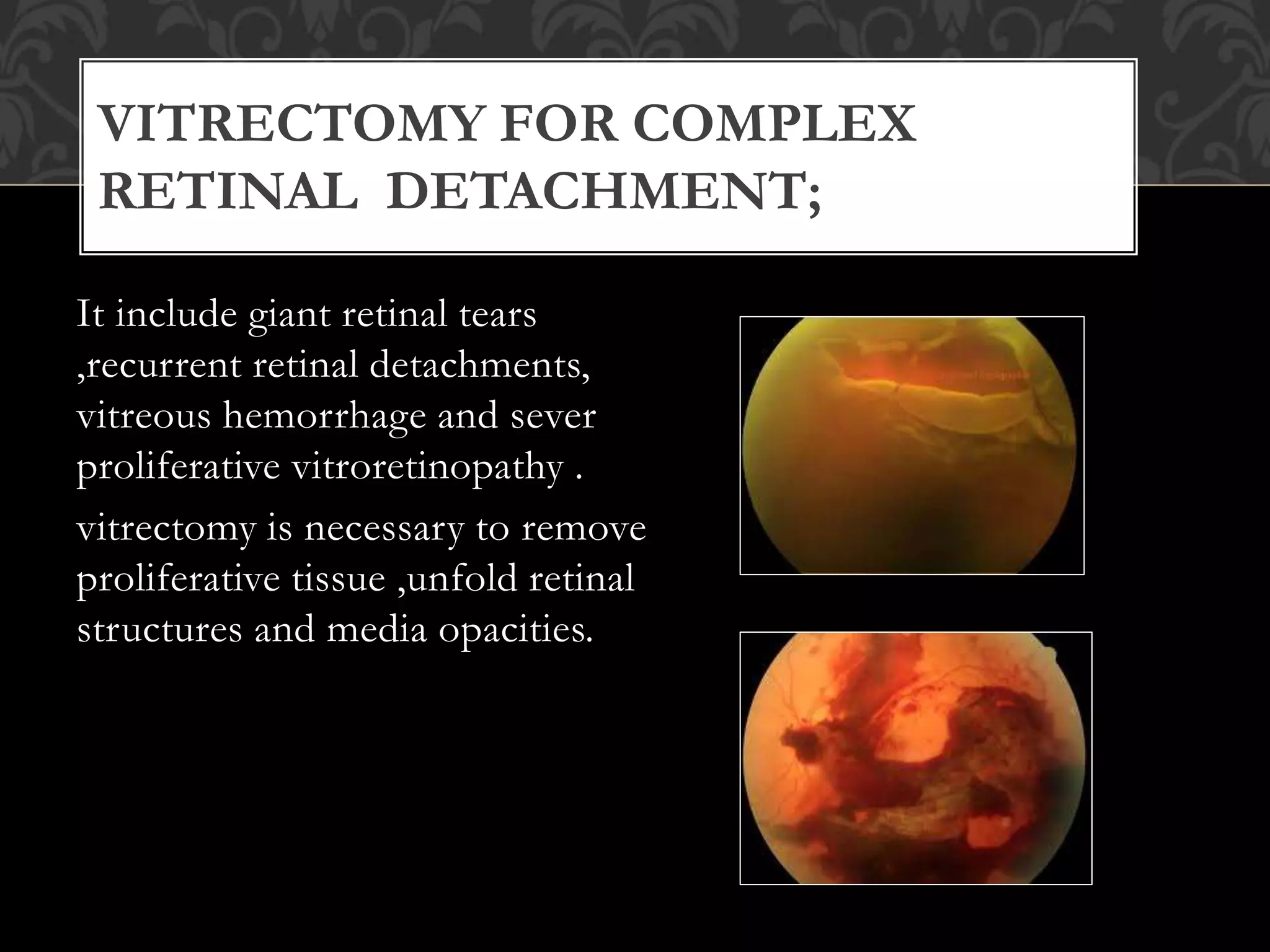 Vitrectomy Types Types of vitrectomy ,indication s and complications | PPTX