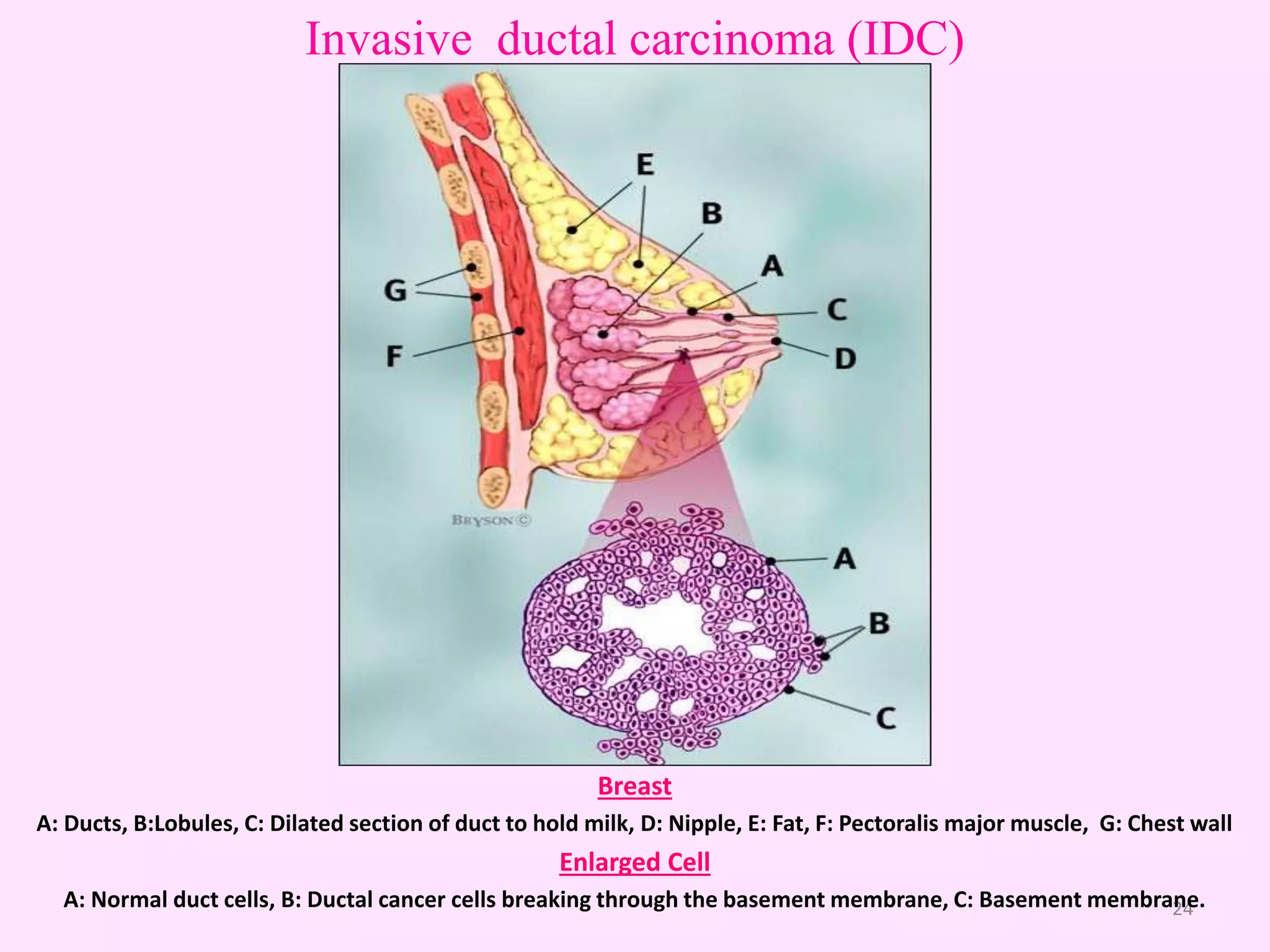 Types & Sub-types of Breast Cancer | PPTX | Cancer | Diseases and ...