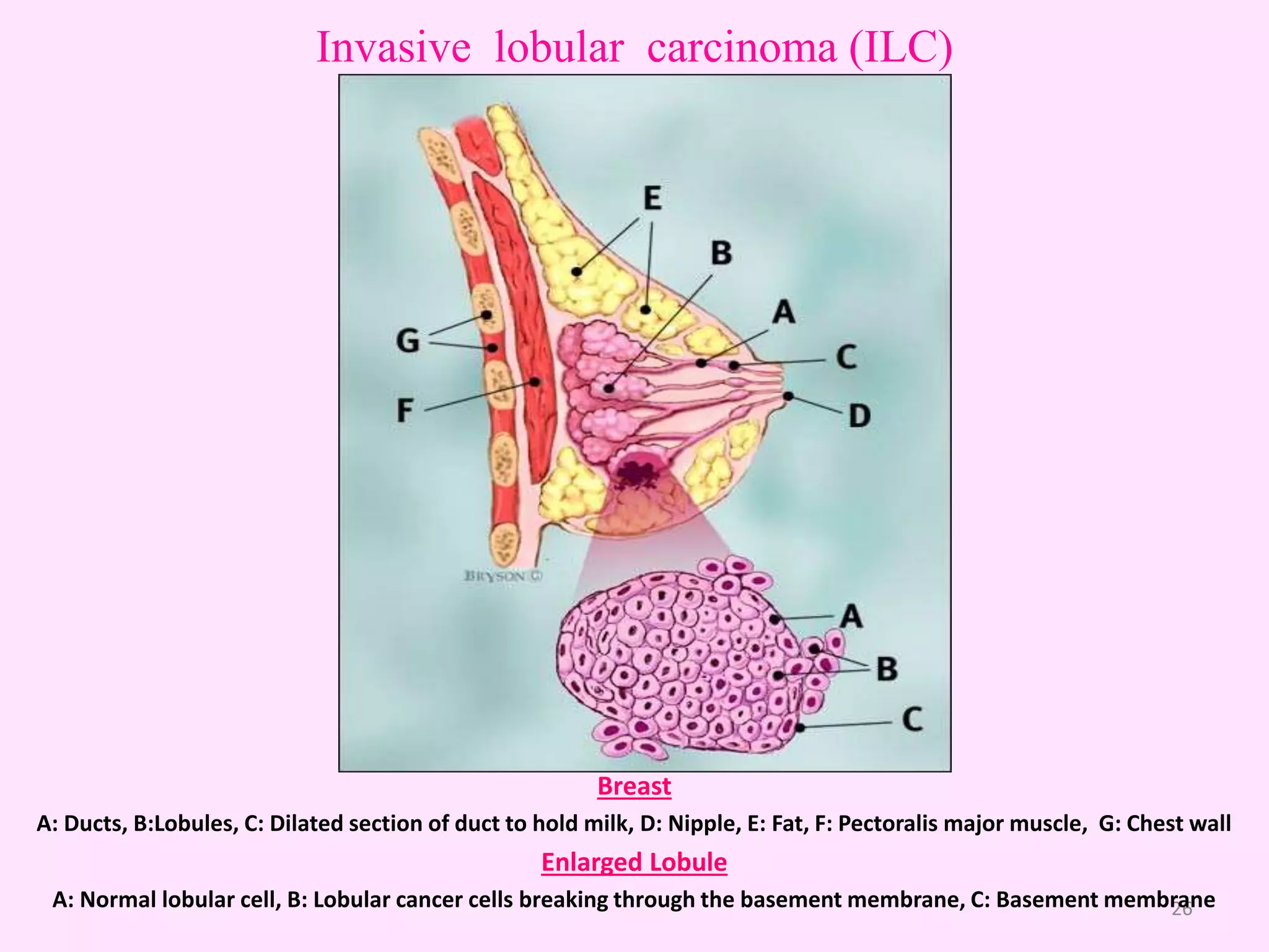 Types & Sub-types of Breast Cancer | PPTX