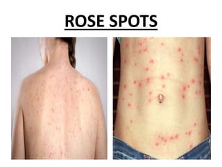 ROSE SPOTS
 